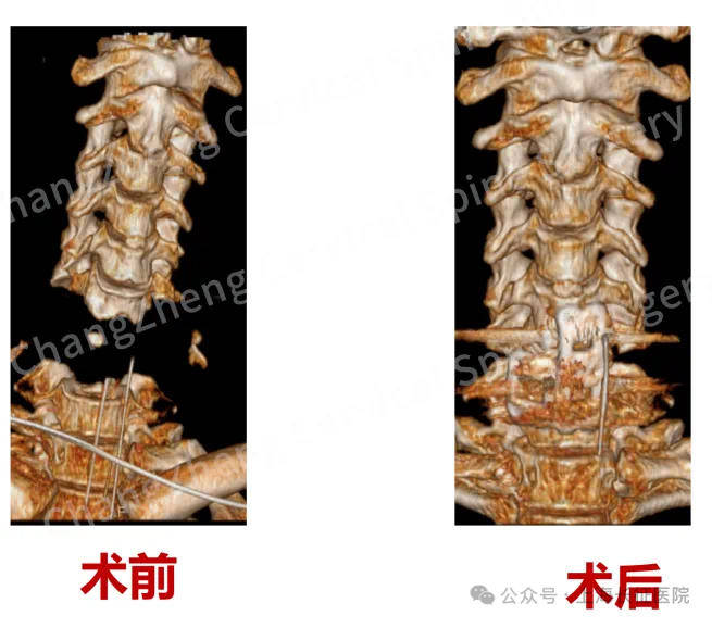 全球罕见!“身首离断”患者被救回 主刀医生:术毕两月整,已脱离呼吸机半月
